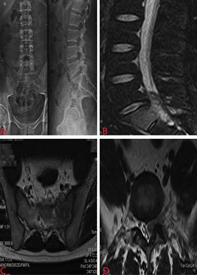 Sacral Ewing sarcoma with rib, lung, and multifocal skull metastases: A rare case report and review of treatments